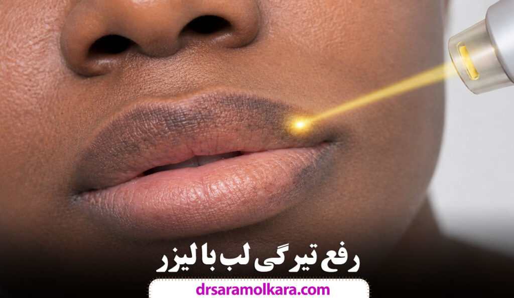 رفع تیرگی لب با لیزر