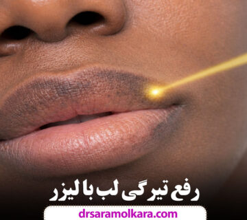 رفع تیرگی لب با لیزر