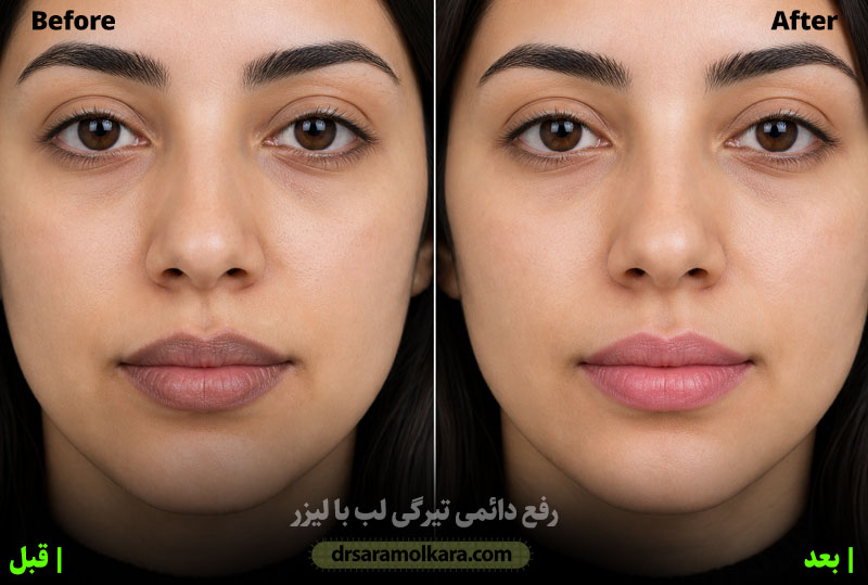 رفع دائمی تیرگی لب با لیزر