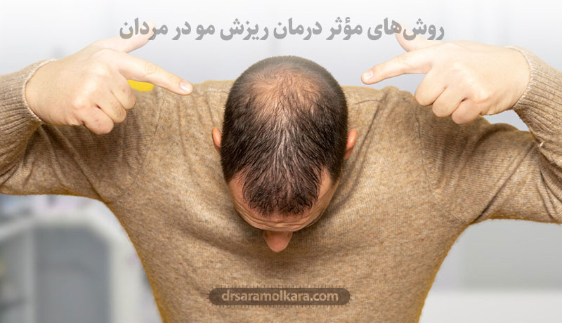 روش‌های مؤثر درمان ریزش مو در مردان