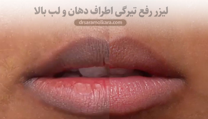 لیزر رفع تیرگی اطراف دهان و لب بالا