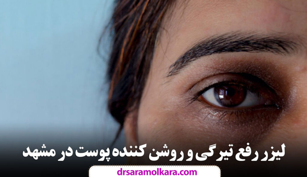 لیزر رفع تیرگی و روشن کننده پوست در مشهد