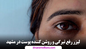 لیزر رفع تیرگی و روشن کننده پوست در مشهد