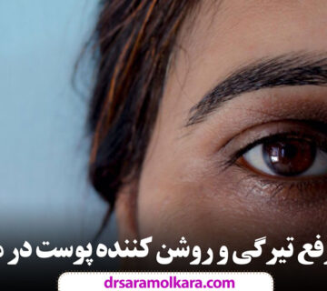 لیزر رفع تیرگی و روشن کننده پوست در مشهد