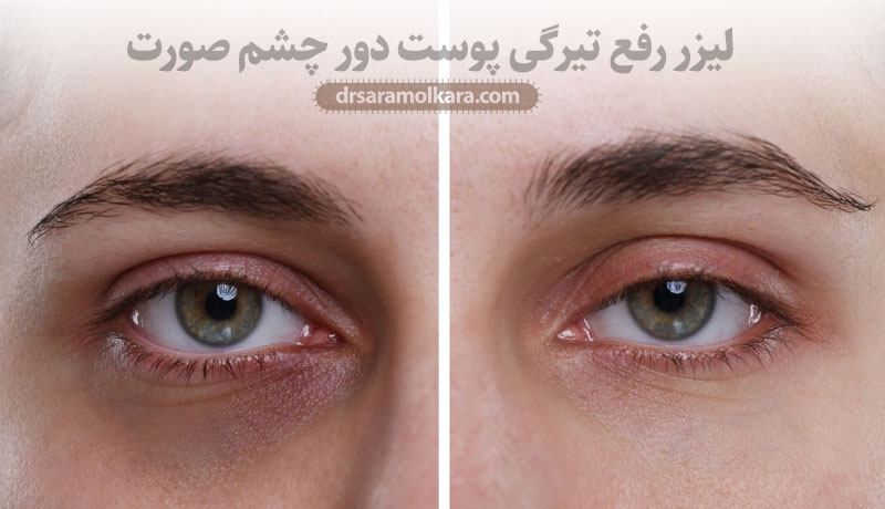 لیزر رفع تیرگی پوست دور چشم صورت