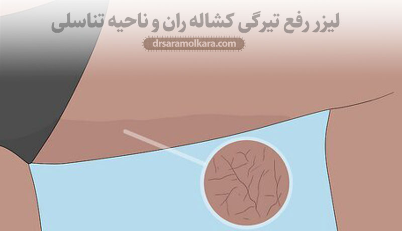 لیزر رفع تیرگی کشاله ران و ناحیه تناسلی