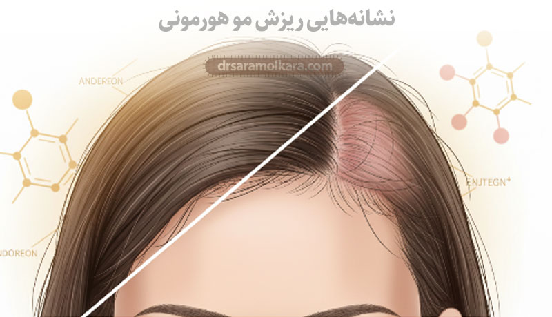 نشانه‌هایی ریزش مو هورمونی